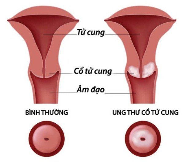 Ung thư cổ tử cung - Nỗi lo của người phụ nữ 1