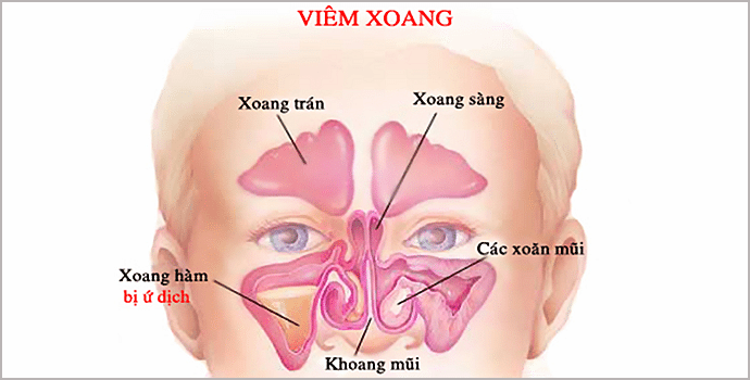 nguyen nhan, trieu chung, cach chua viem xoang 1